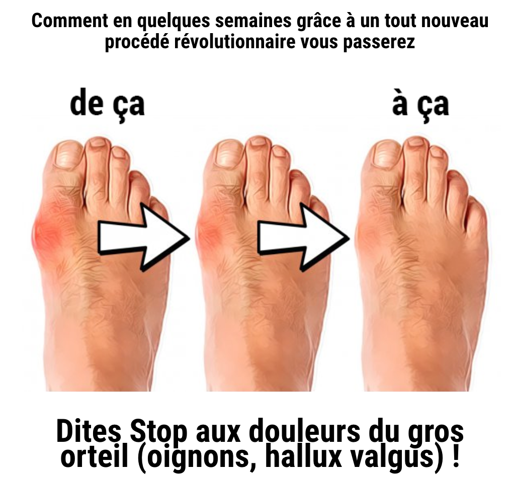 Correcteur de hallux valgus - Soulagement et redressement du gros orteil