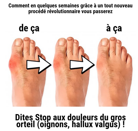 Correcteur de hallux valgus - Soulagement et redressement du gros orteil