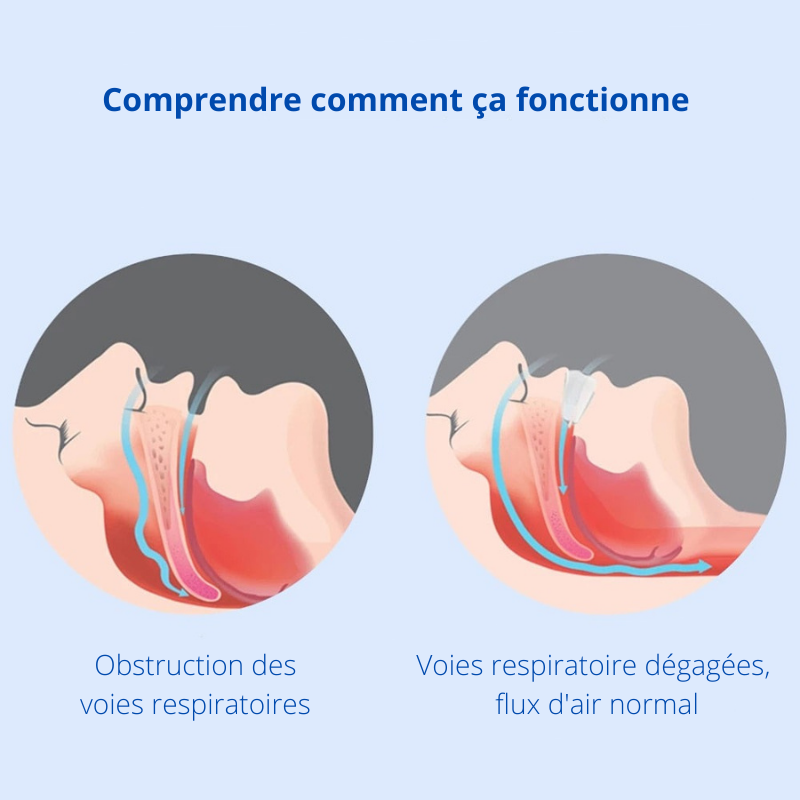 Appareil Buccal Anti-Ronflement pour un Sommeil Revitalisant