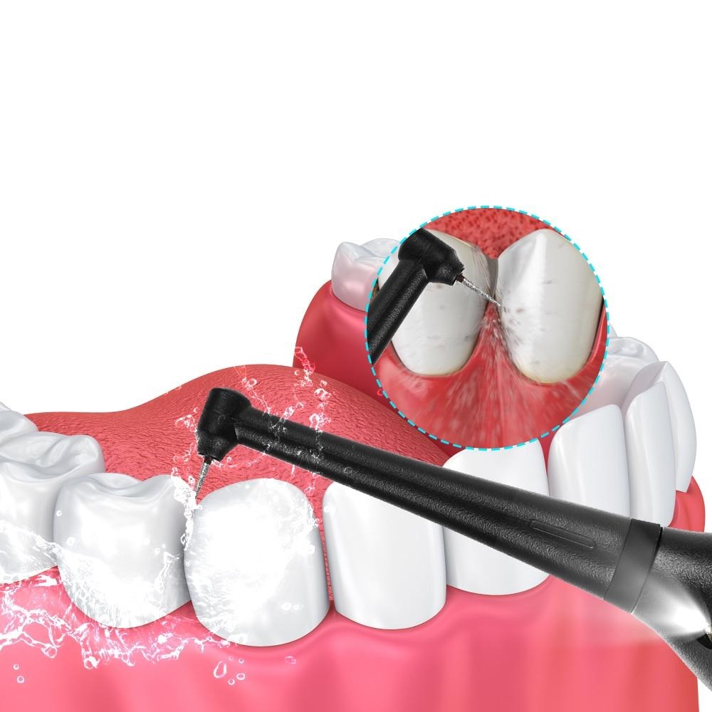 Détartreur Dentaire Électrique : Nettoyez Comme un Pro à Domicile