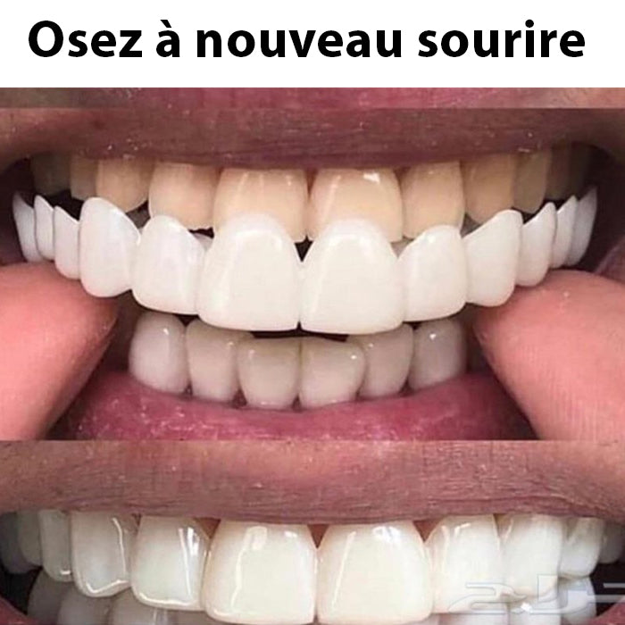 Facette Dentaire Blanche Élégante pour un Sourire Éblouissant