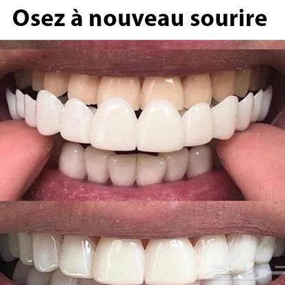Facette Dentaire Blanche Élégante pour un Sourire Éblouissant