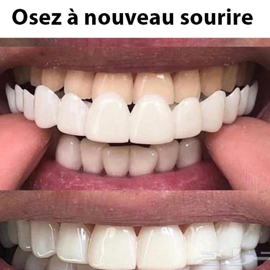 Facette Dentaire Blanche Élégante pour un Sourire Éblouissant