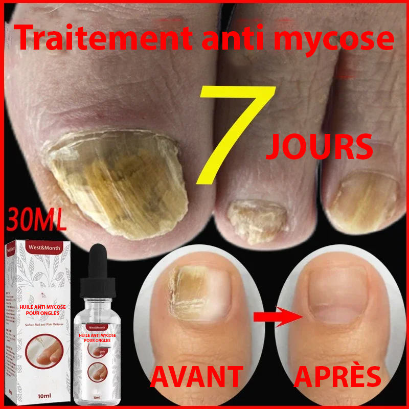 Traitement Onychomycoses - Soin Efficace pour Ongles