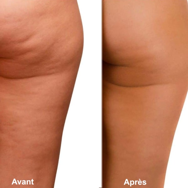 Ventouse Électrique Anti-Cellulite Intelligente avec Chauffage et Luminothérapie