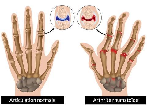 Mitaines de Compression Antidouleurs pour Arthrose et Douleurs Articulaires