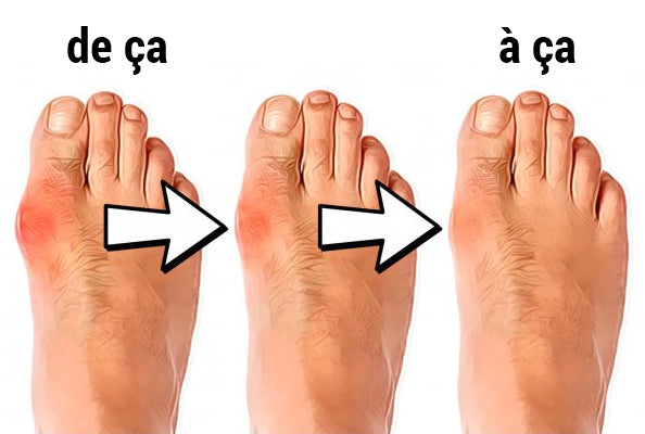 Correcteur de hallux valgus - Soulagement et redressement du gros orteil