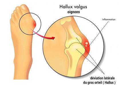 Correcteur de hallux valgus - Soulagement et redressement du gros orteil